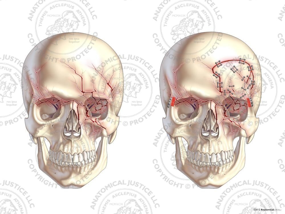 Anterior Skull Fractures with Left Craniotomy and Repairs – No Text