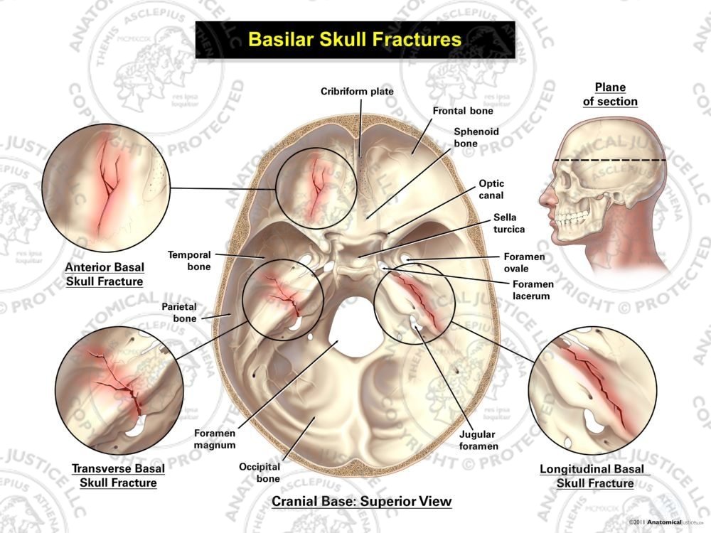 Basilar Skull Fractures