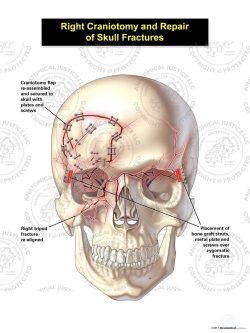 Right Craniotomy and Repair of Skull Fractures