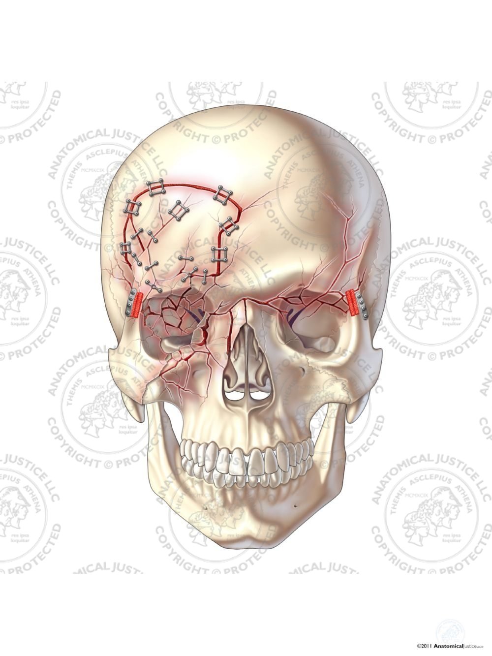 Right Craniotomy and Repair of Skull Fractures – No Text