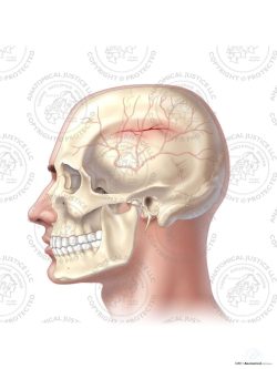 Left Middle Meningeal Artery Injury – No Text