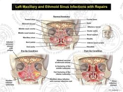 Left Maxillary and Ethmoid Sinus Infections with Repairs