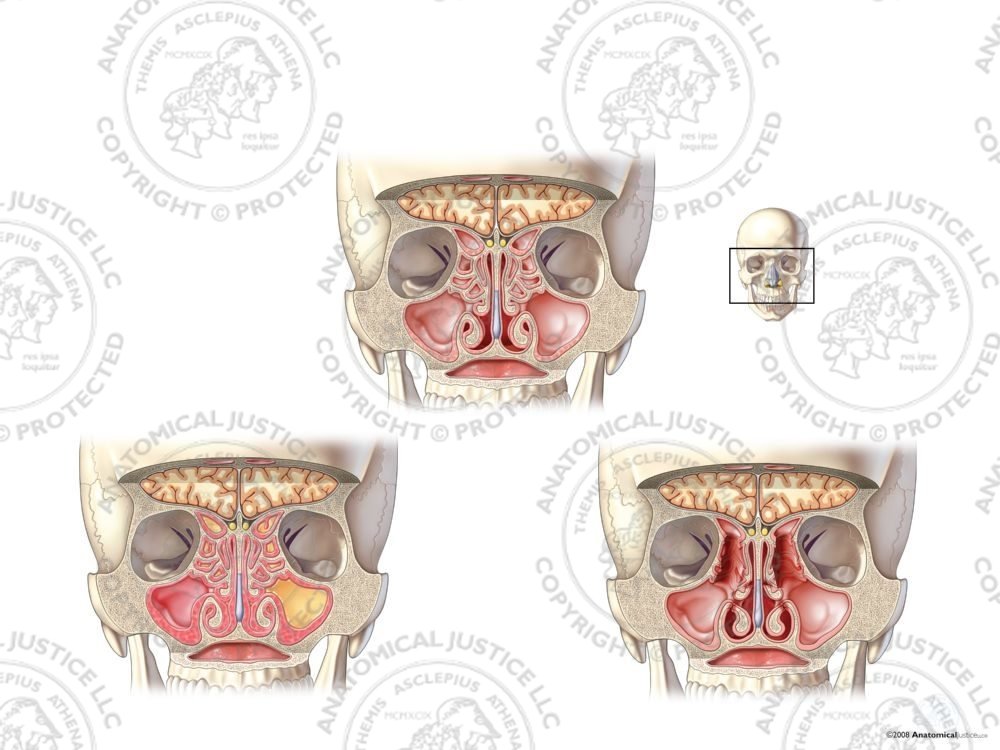 Left Maxillary and Ethmoid Sinus Infections with Repairs – No Text