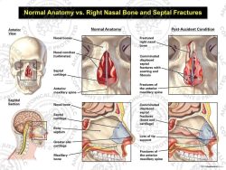 Normal Anatomy vs. Right Nasal Bone and Septal Fractures