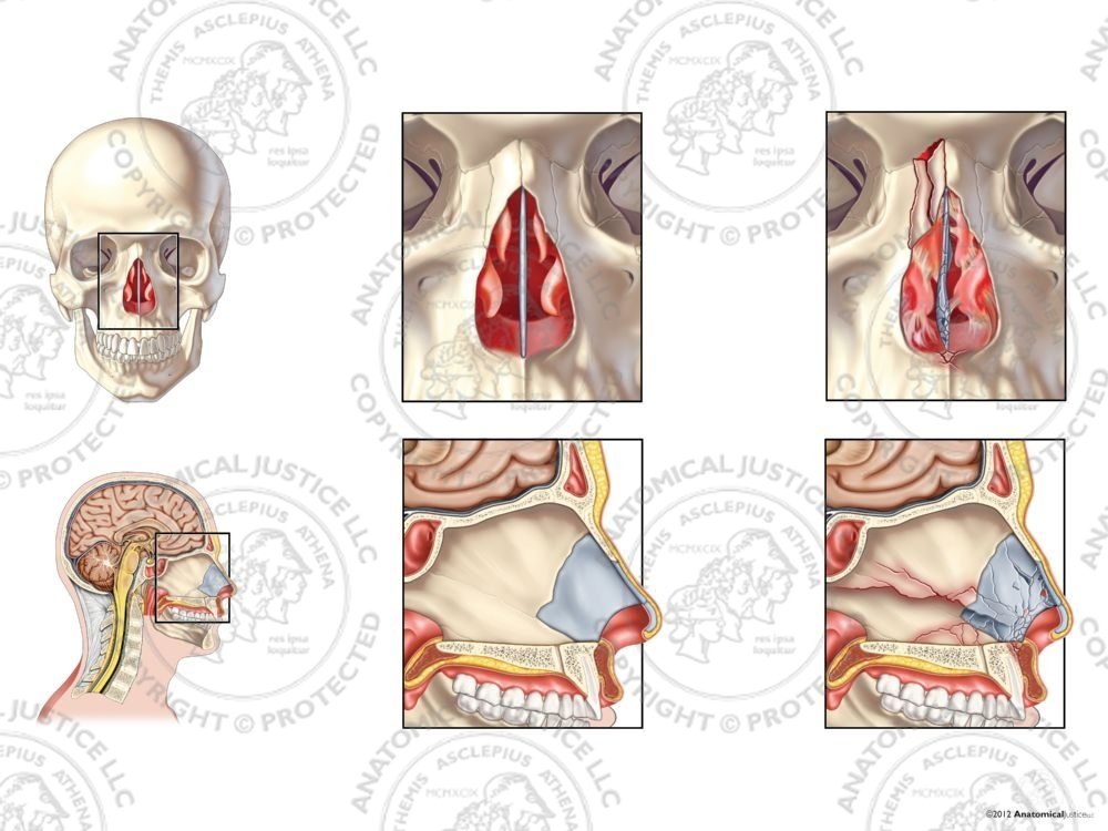 Normal Anatomy vs. Right Nasal Bone and Septal Fractures – No Text