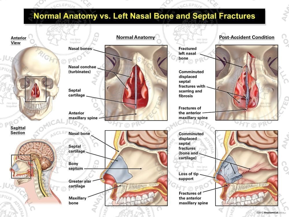 Normal Anatomy vs. Left Nasal Bone and Septal Fractures