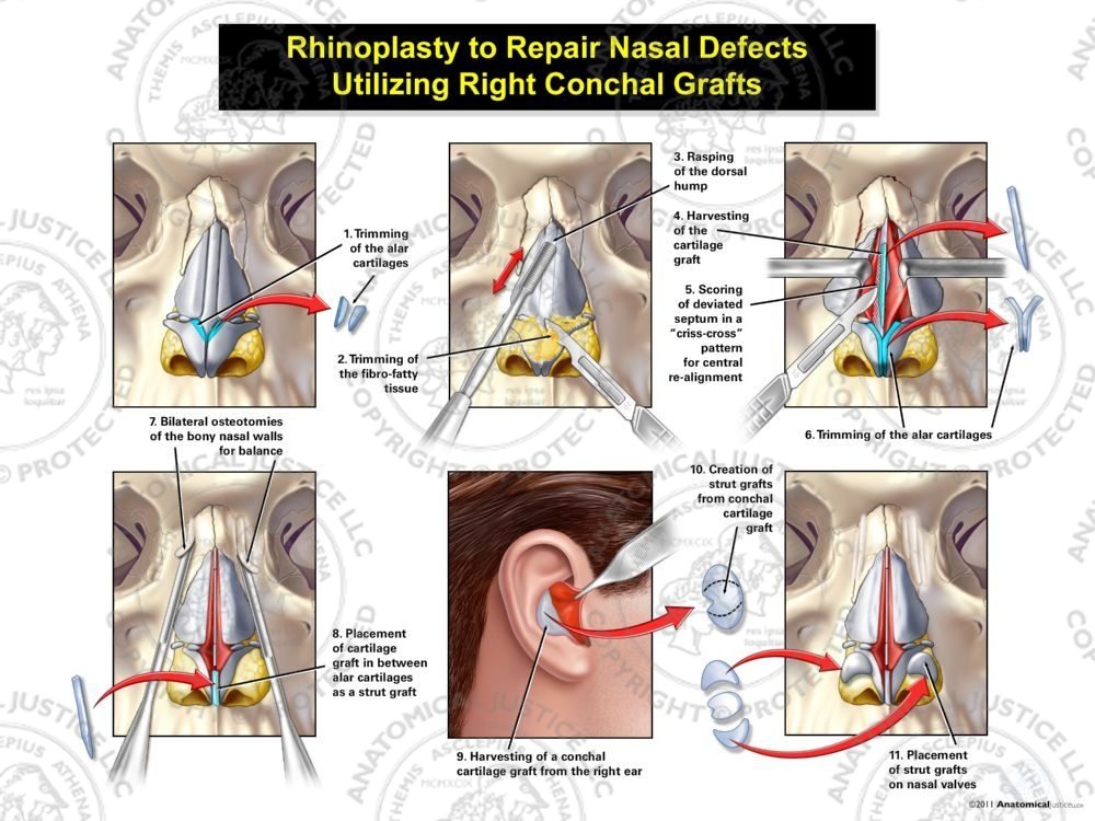 Rhinoplasty to Repair Nasal Defects Utilizing Right Conchal Grafts