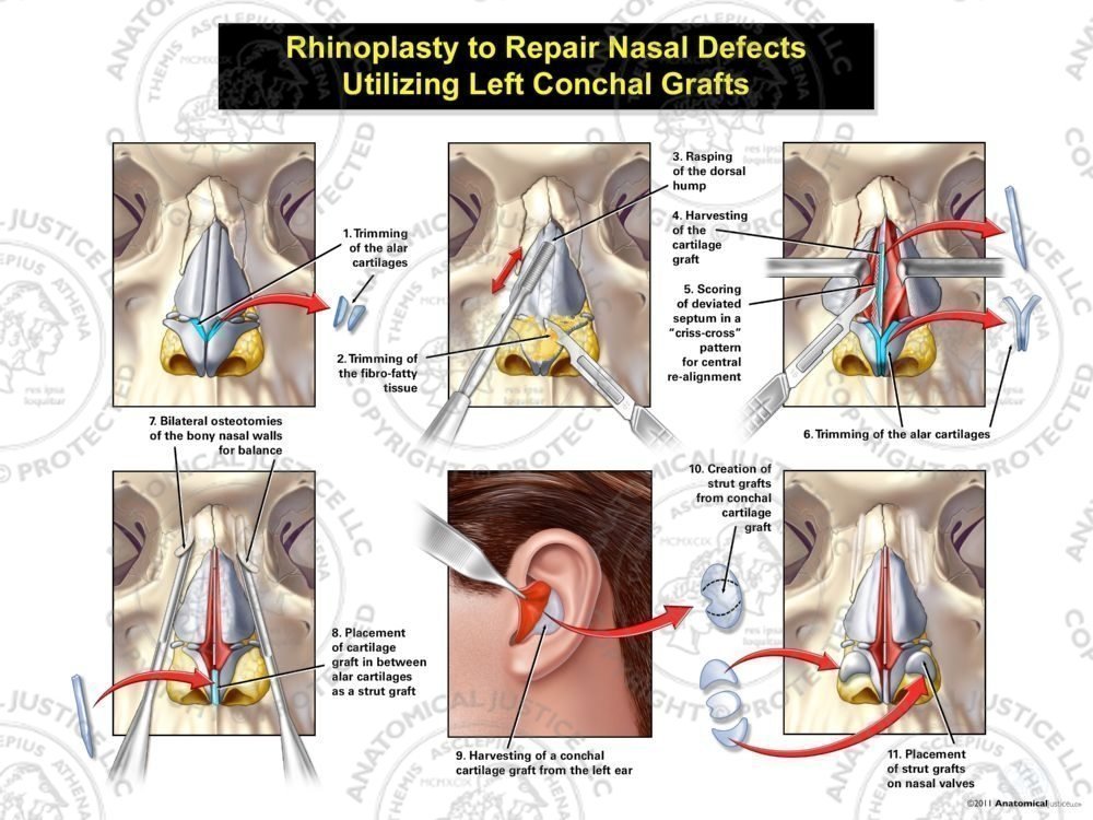 Rhinoplasty to Repair Nasal Defects Utilizing Left Conchal Grafts