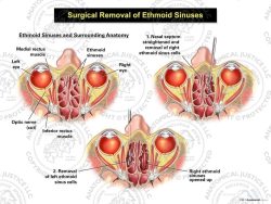 Surgical Removal of Ethmoid Sinuses