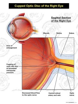 Cupped Optic Disc of the Right Eye