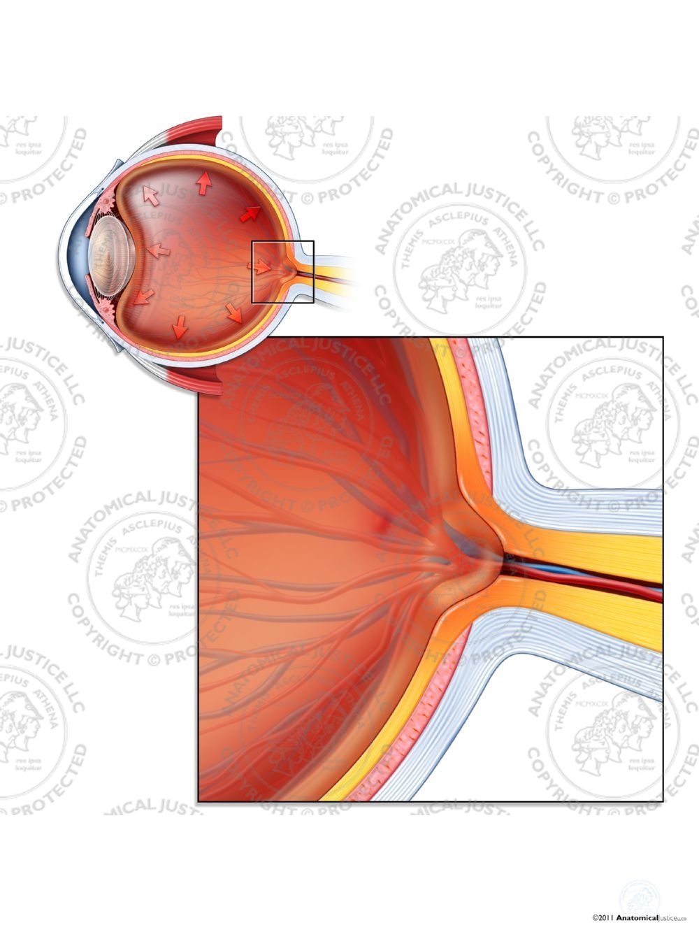 Cupped Optic Disc of the Right Eye – No Text