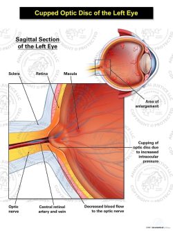 Cupped Optic Disc of the Left Eye