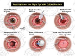 Enucleation of the Right Eye with Orbital Implant