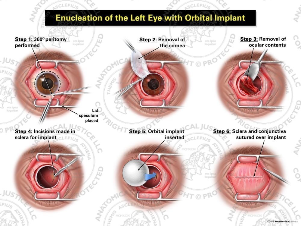 Enucleation of the Left Eye with Orbital Implant