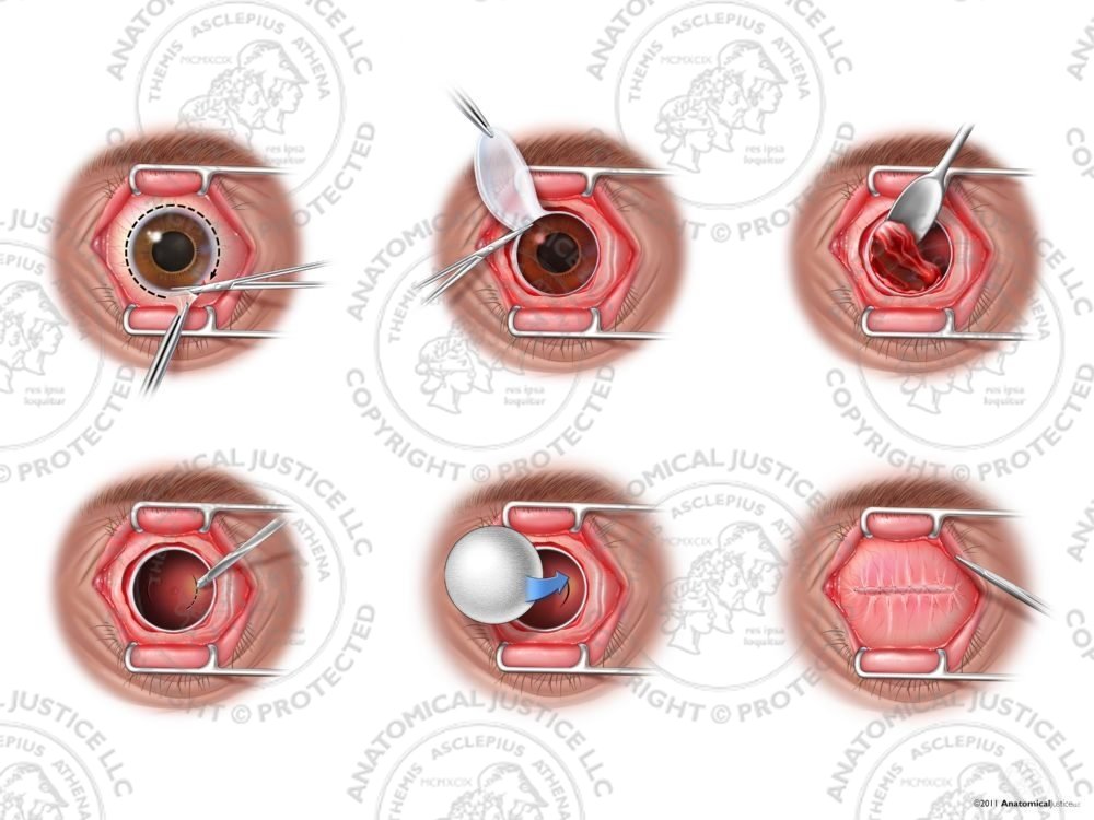 Enucleation of the Left Eye with Orbital Implant – No Text