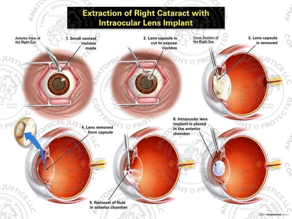 Verslaafd kraai Cokes Extraction of Right Cataract with Intraocular Lens Implant