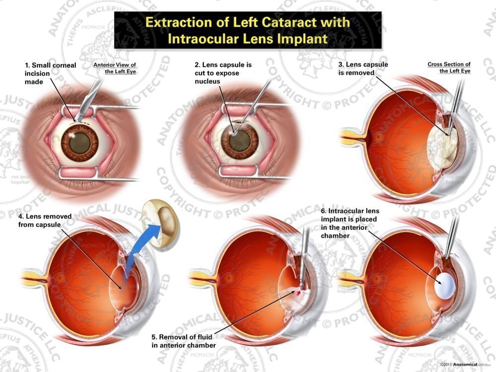 Extraction of Left Cataract with Intraocular Lens Implant