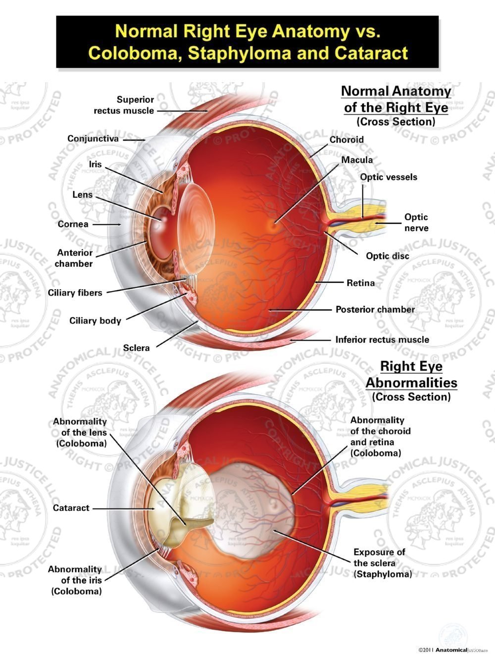 Normal Right Eye Anatomy vs. Coloboma, Staphyloma, and Cataract