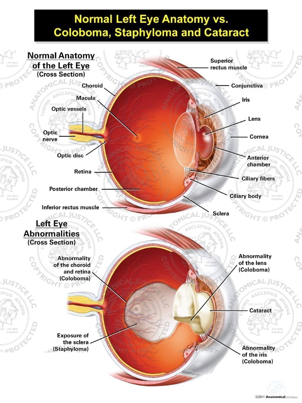 Normal Left Eye Anatomy vs. Coloboma, Staphyloma, and Cataract