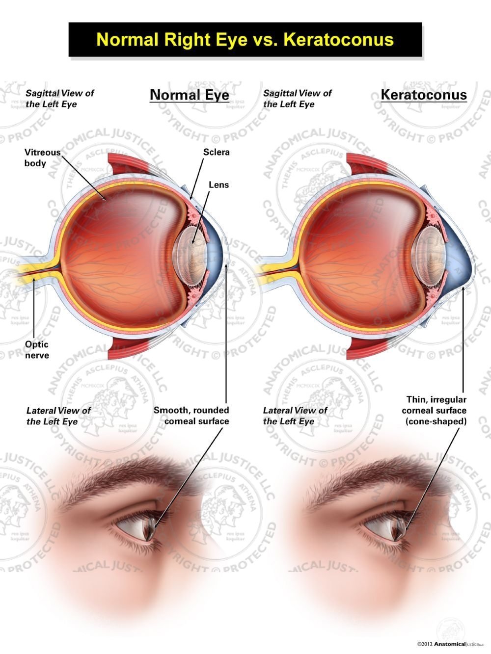 Normal Right Eye vs. Keratoconus