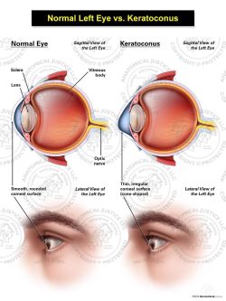 Normal Left Eye vs. Keratoconus