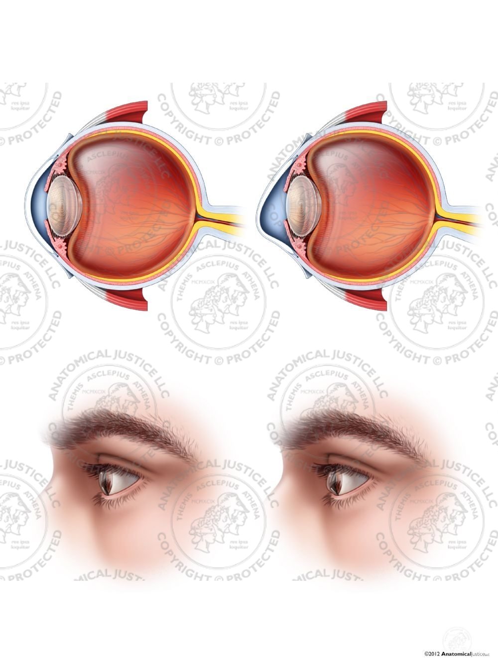 Normal Left Eye vs. Keratoconus – No Text