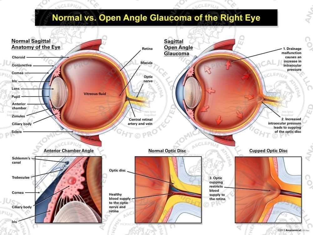 Normal vs. Open Angle Glaucoma of the Right Eye