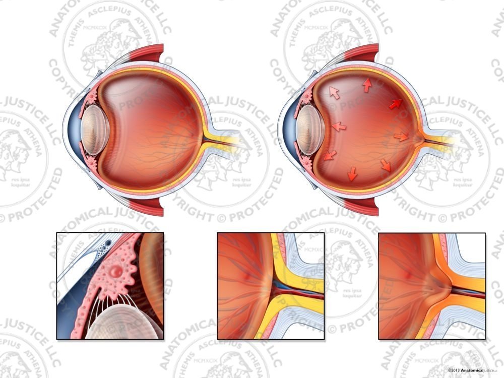 Normal vs. Open Angle Glaucoma of the Right Eye – No Text