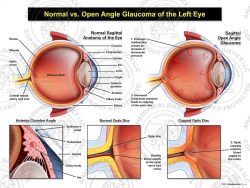 Normal vs. Open Angle Glaucoma of the Left Eye