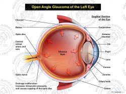 Open Angle Glaucoma of the Left Eye