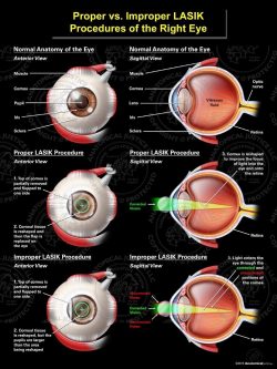 Proper vs. Improper LASIK of the Right Eye