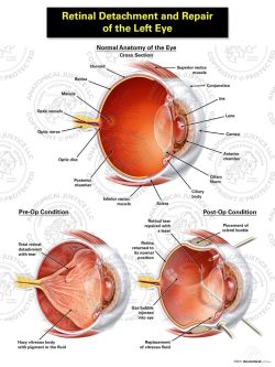 Retinal Detachment and Repair of the Left Eye