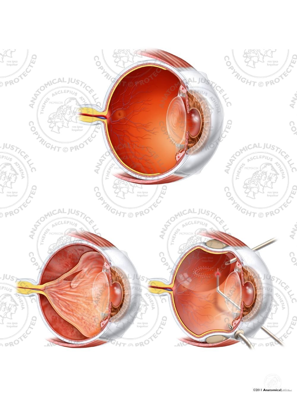 Retinal Detachment and Repair of the Left Eye – No Text