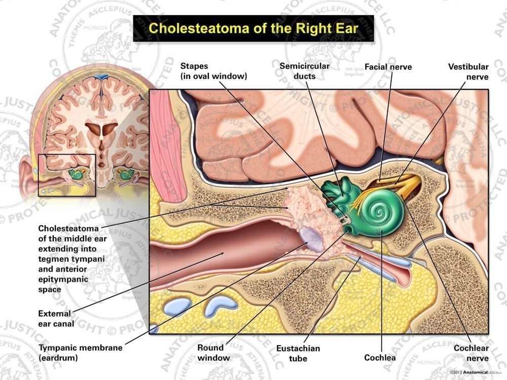 Cholesteatoma of the Right Ear