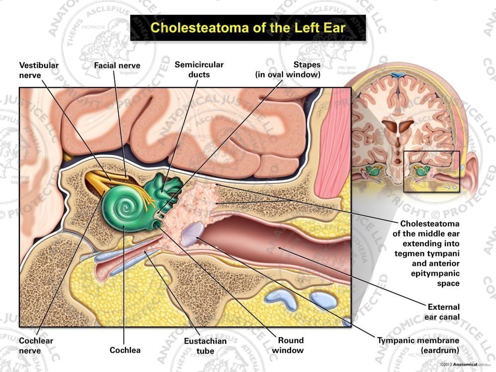 Cholesteatoma of the Left Ear