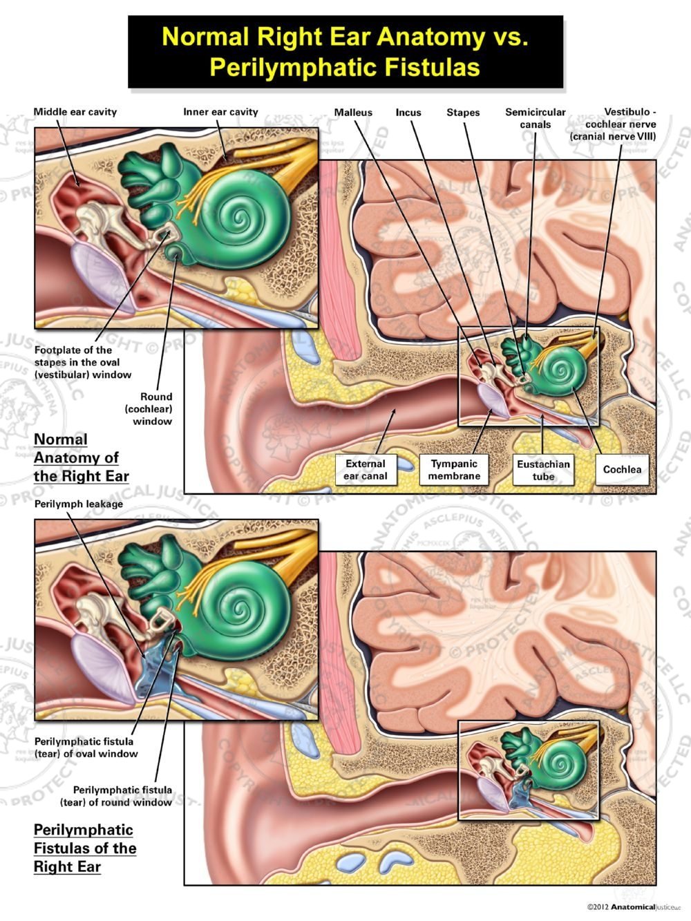 Normal Right Ear Anatomy vs. Perilymphatic Fistulas