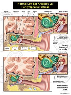 Normal Left Ear Anatomy vs. Perilymphatic Fistulas