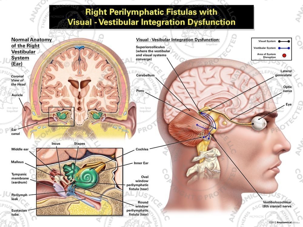 Male Right Perilymphatic Fistulas with Visual – Vestibular Integration Dysfunction