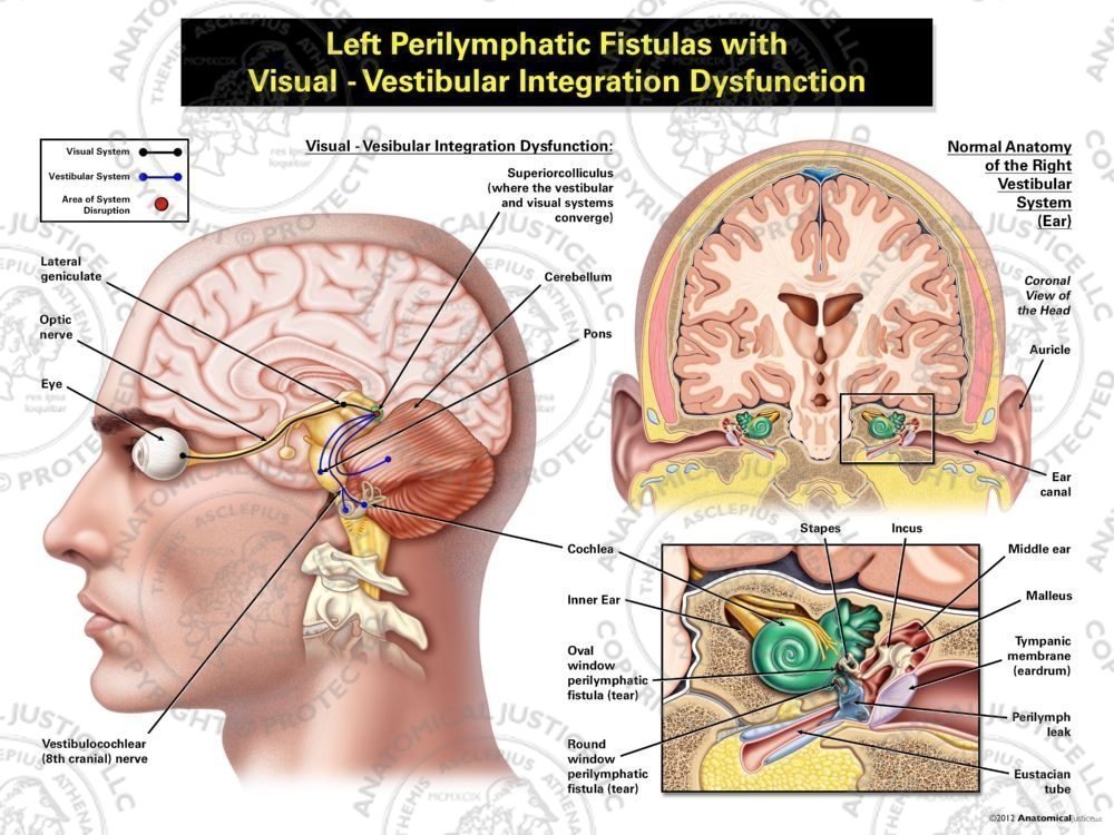 Male Left Perilymphatic Fistulas with Visual – Vestibular Integration Dysfunction