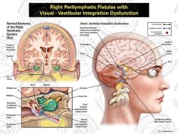 Female Right Perilymphatic Fistulas with Visual – Vestibular Integration Dysfunction