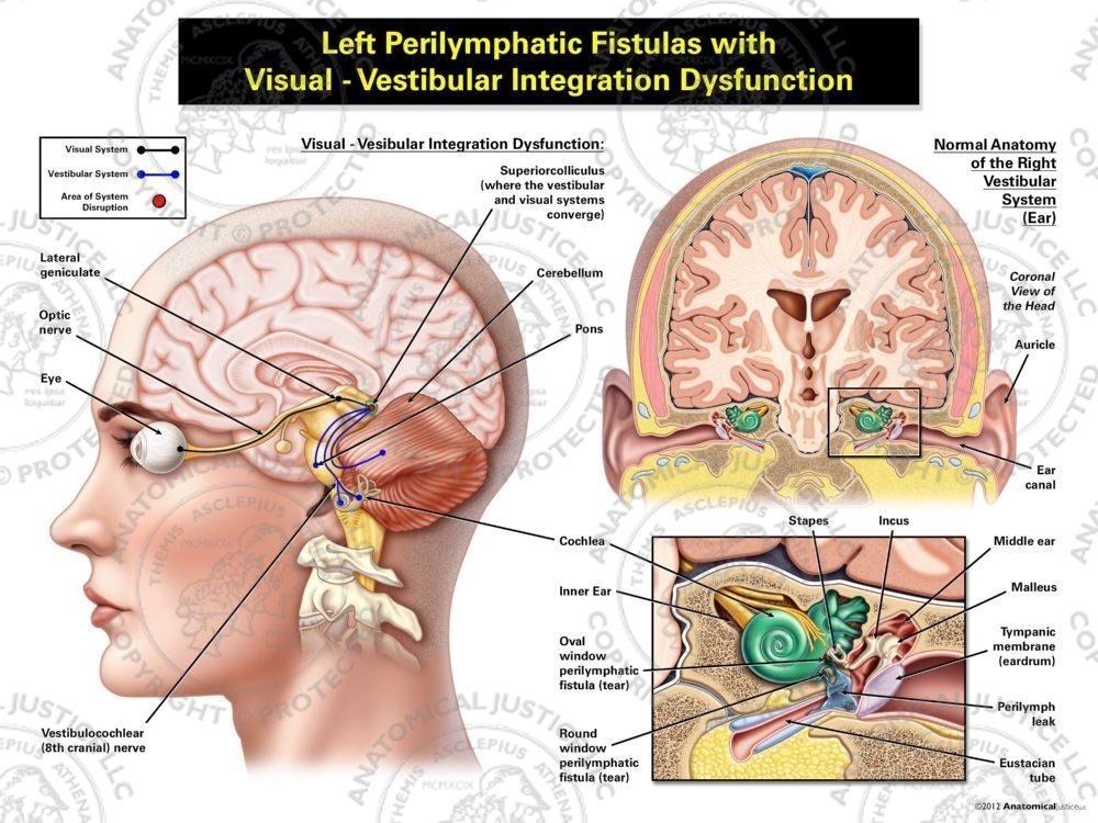 Female Left Perilymphatic Fistulas with Visual – Vestibular Integration Dysfunction