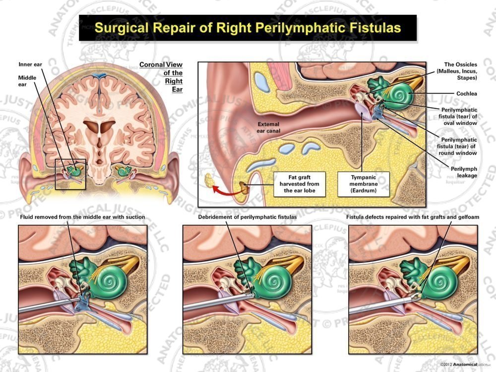 Surgical Repair of Right Perilymphatic Fistulas