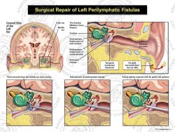 Surgical Repair of Left Perilymphatic Fistulas
