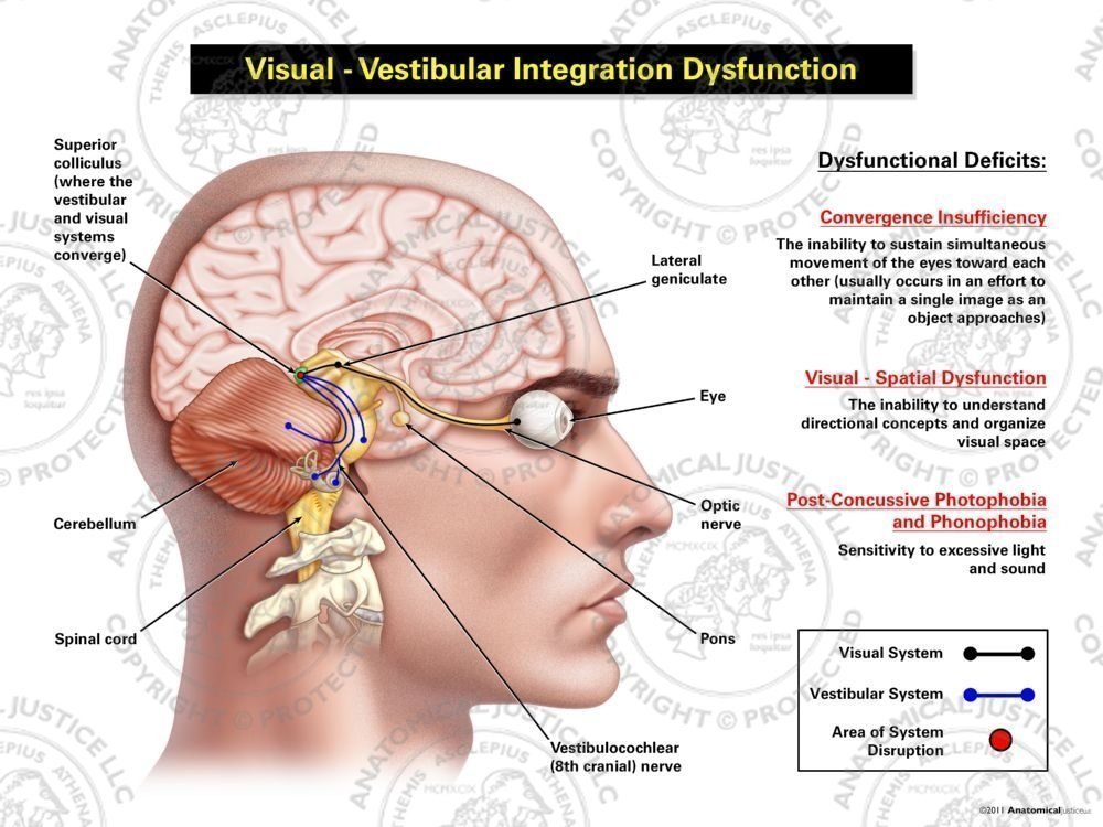 Male Right Visual – Vestibular Integration Dysfunction