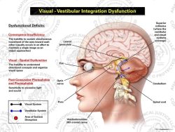 Female Left Visual – Vestibular Integration Dysfunction