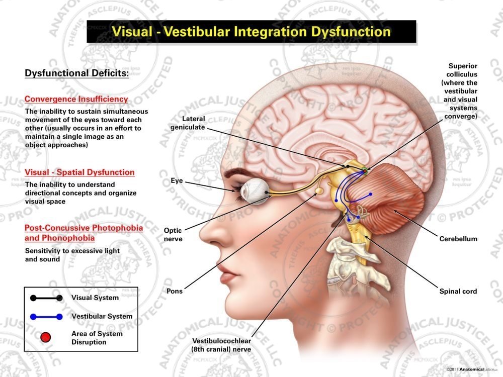 Female Left Visual – Vestibular Integration Dysfunction
