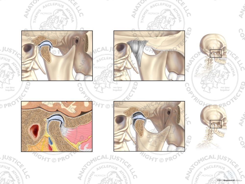 Anatomy of the Right Temporomandibular Joint (TMJ) No Text
