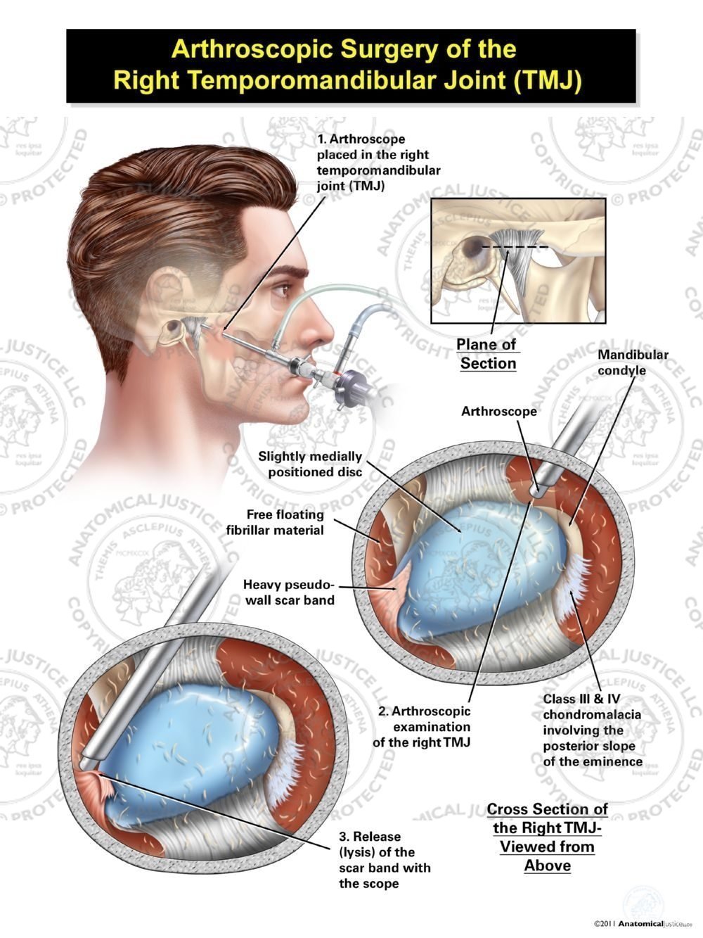 Arthroscopic Surgery of Temporomandibular Joint TMJ | Medical Illustration