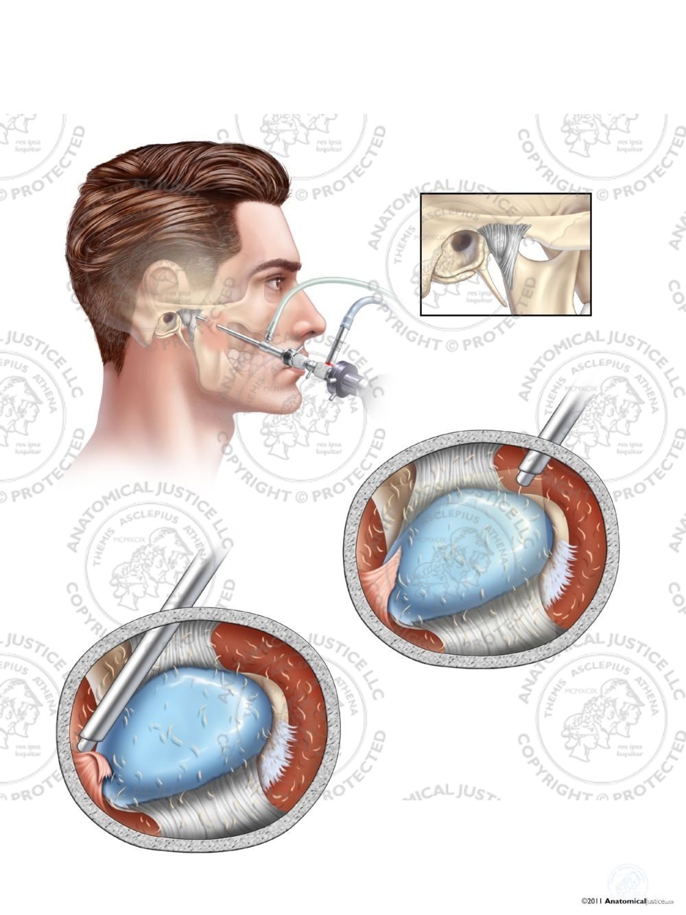 Male Arthroscopic Surgery of the Right Temporomandibular Joint (TMJ) – No Text