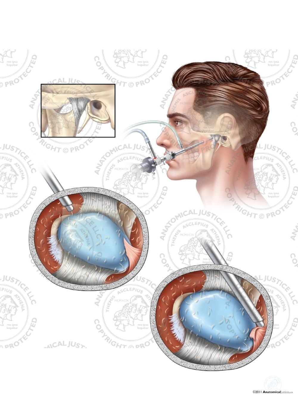 Male Arthroscopic Surgery of the Left Temporomandibular Joint (TMJ) – No Text